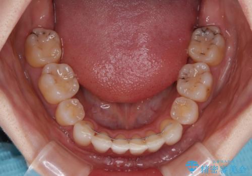 【モニター】顎のゆがみをカムフラージュ ワイヤー装置の抜歯矯正の治療後