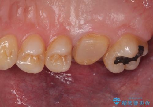 歯が割れた オールセラミッククラウンの治療中