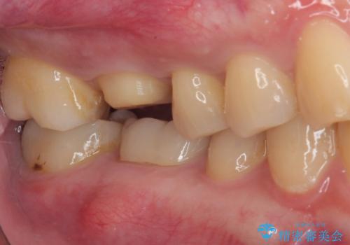 歯が割れた オールセラミッククラウンの治療中