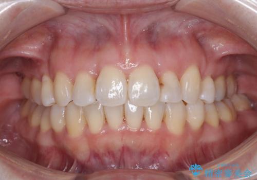 飛び出した上顎前歯と上下のデコボコ 片顎の抜歯によるワイヤー矯正の治療後