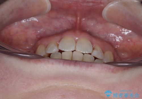 飛び出した上顎前歯と上下のデコボコ 片顎の抜歯によるワイヤー矯正の治療後