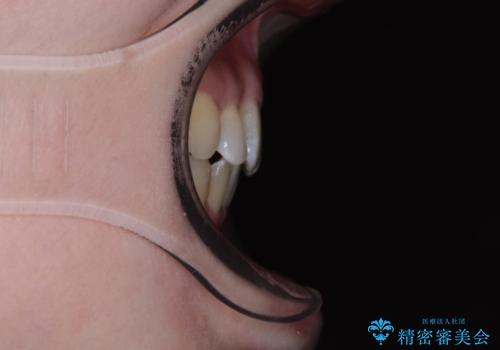 飛び出した上顎前歯と上下のデコボコ 片顎の抜歯によるワイヤー矯正の治療後