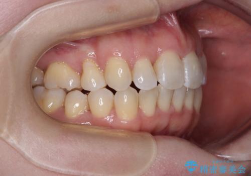 飛び出した上顎前歯と上下のデコボコ 片顎の抜歯によるワイヤー矯正の治療後
