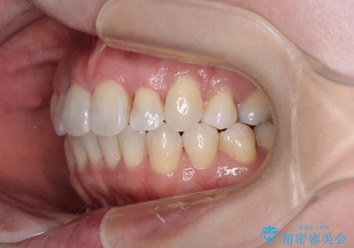 飛び出した上顎前歯と上下のデコボコ 片顎の抜歯によるワイヤー矯正の治療後