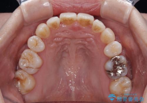 飛び出した上顎前歯と上下のデコボコ 片顎の抜歯によるワイヤー矯正の治療後