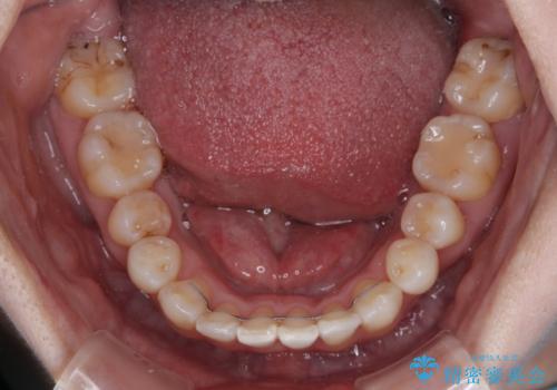飛び出した上顎前歯と上下のデコボコ 片顎の抜歯によるワイヤー矯正の治療後