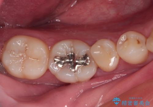 繰り返す痛み 下顎小臼歯の再根管治療の症例 治療前