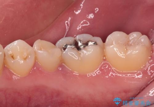 繰り返す痛み 下顎小臼歯の再根管治療の治療前