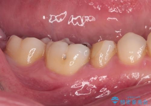 繰り返す痛み 下顎小臼歯の再根管治療の治療前