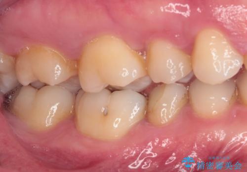 繰り返す痛み 下顎小臼歯の再根管治療の治療前
