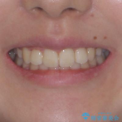 デコボコと出っ歯 抜歯矯正でスッキリとした口元にの治療後(顔貌)