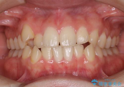 八重歯とクロスバイト:インビザライン治療