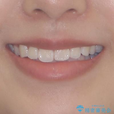 インビザライン・モデレートを用いて気になる前歯を矯正治療の治療前(顔貌)