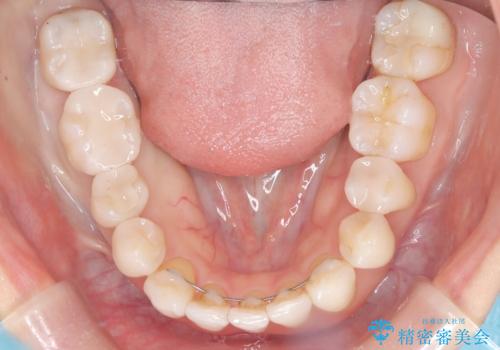 【セラミックインレー】口の中を白くしたいの治療後
