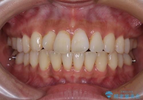 【モニター】上顎前突と奥歯の鋏状咬合 補助装置を用いたインビザライン矯正治療の治療中