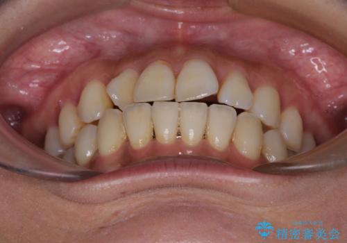 【モニター】上顎前突と奥歯の鋏状咬合 補助装置を用いたインビザライン矯正治療の治療中