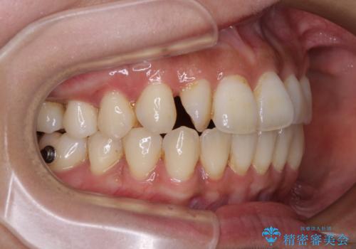 【モニター】上顎前突と奥歯の鋏状咬合 補助装置を用いたインビザライン矯正治療の治療中