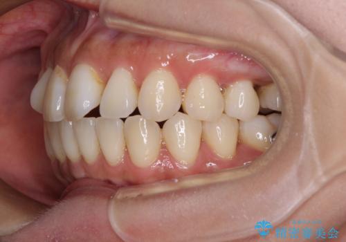 【モニター】上顎前突と奥歯の鋏状咬合 補助装置を用いたインビザライン矯正治療の治療中