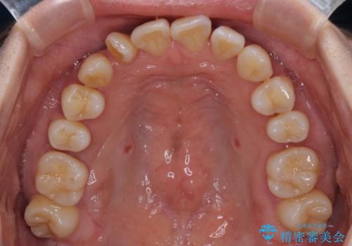 【モニター】上顎前突と奥歯の鋏状咬合 補助装置を用いたインビザライン矯正治療の治療中