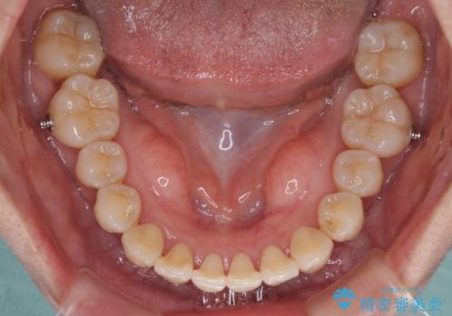 【モニター】上顎前突と奥歯の鋏状咬合 補助装置を用いたインビザライン矯正治療の治療中