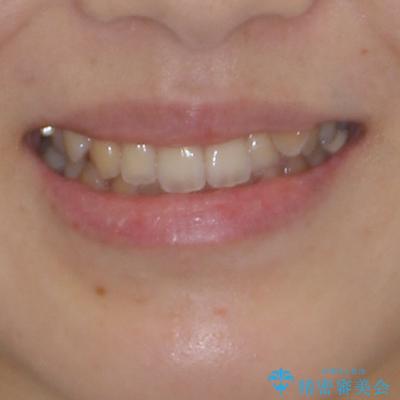 急速拡大装置 狭い上顎骨を拡大してワイヤー装置で八重歯を短期間治療の治療前(顔貌)
