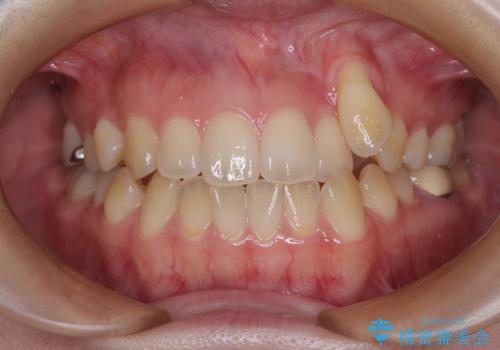 急速拡大装置　狭い上顎骨を拡大してワイヤー装置で八重歯を短期間治療の症例 治療前
