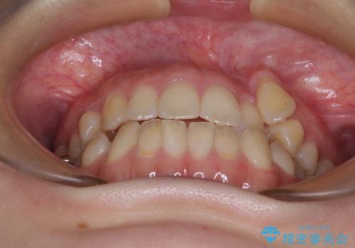 急速拡大装置 狭い上顎骨を拡大してワイヤー装置で八重歯を短期間治療の治療前