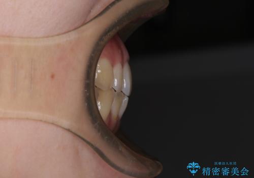 急速拡大装置 狭い上顎骨を拡大してワイヤー装置で八重歯を短期間治療の治療前