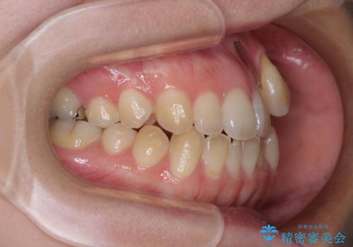 急速拡大装置 狭い上顎骨を拡大してワイヤー装置で八重歯を短期間治療の治療前