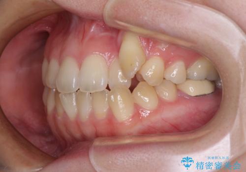 急速拡大装置 狭い上顎骨を拡大してワイヤー装置で八重歯を短期間治療の治療前