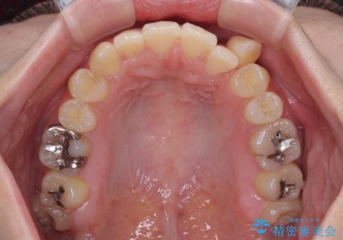 急速拡大装置 狭い上顎骨を拡大してワイヤー装置で八重歯を短期間治療の治療前