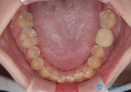 急速拡大装置 狭い上顎骨を拡大してワイヤー装置で八重歯を短期間治療の治療前
