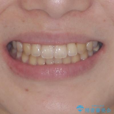 急速拡大装置 狭い上顎骨を拡大してワイヤー装置で八重歯を短期間治療の治療後(顔貌)