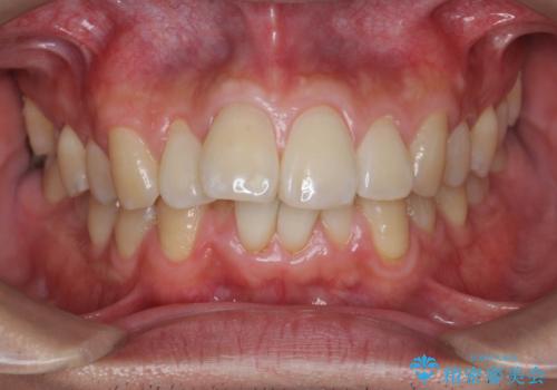 マウスピース矯正で前歯の角度、ガタガタをきれいにの症例 治療前