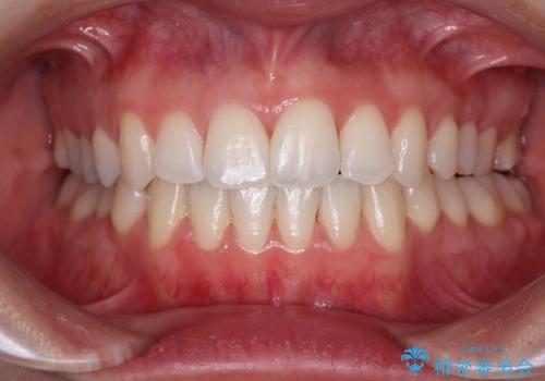 骨格的な問題を側方拡大で解決 ワイヤー矯正治療の症例 治療後