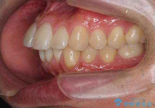 マウスピース矯正で前歯の角度、ガタガタをきれいにの治療前