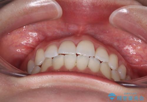 骨格的な問題を側方拡大で解決 ワイヤー矯正治療の治療後