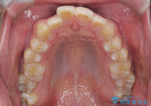 マウスピース矯正で前歯の角度、ガタガタをきれいにの治療前