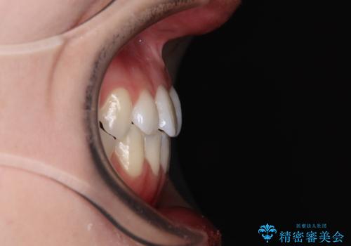 骨格的な問題を側方拡大で解決 ワイヤー矯正治療の治療後