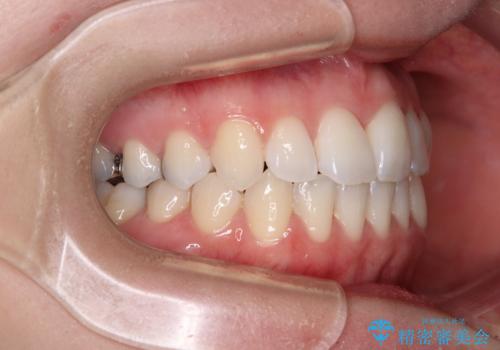 骨格的な問題を側方拡大で解決 ワイヤー矯正治療の治療後