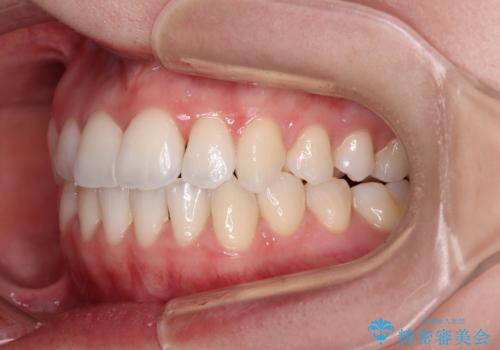 骨格的な問題を側方拡大で解決 ワイヤー矯正治療の治療後