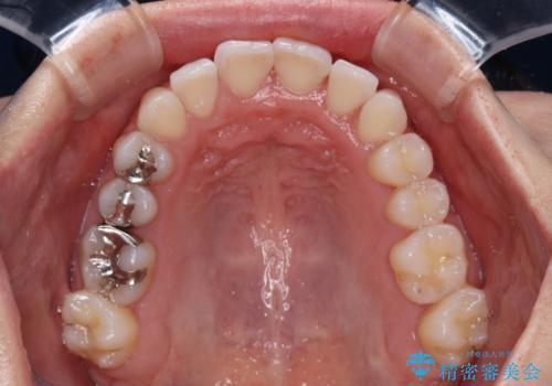 骨格的な問題を側方拡大で解決 ワイヤー矯正治療の治療後