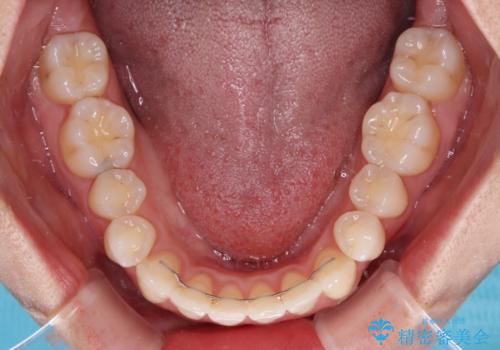 骨格的な問題を側方拡大で解決 ワイヤー矯正治療の治療後