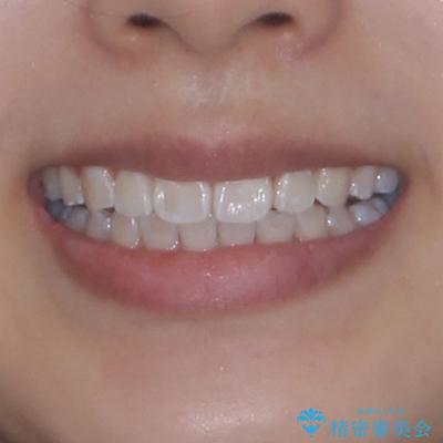 インビザライン・モデレートを用いて気になる前歯を矯正治療の治療後(顔貌)