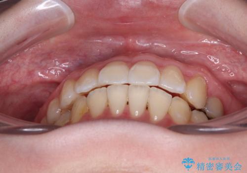 開咬と前方に飛び出した前歯 インビザラインによる矯正治療の治療後