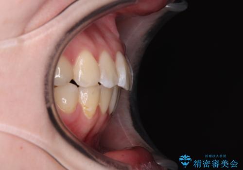 開咬と前方に飛び出した前歯 インビザラインによる矯正治療の治療後