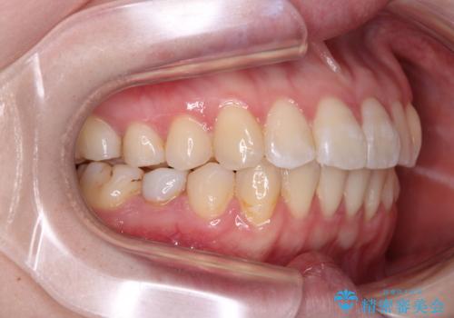 開咬と前方に飛び出した前歯 インビザラインによる矯正治療の治療後