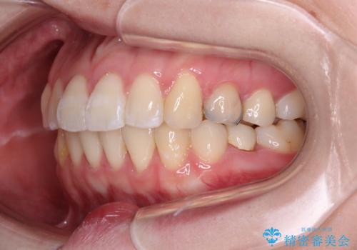 開咬と前方に飛び出した前歯 インビザラインによる矯正治療の治療後