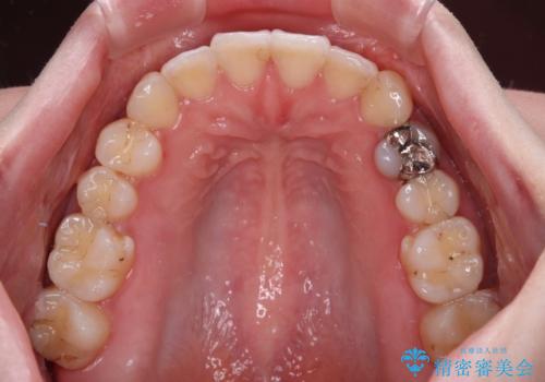 開咬と前方に飛び出した前歯 インビザラインによる矯正治療の治療後