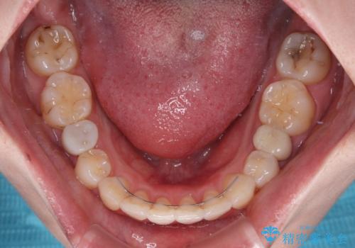 開咬と前方に飛び出した前歯 インビザラインによる矯正治療の治療後